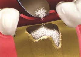 Best Dental clinic im thiruthuraipoondi and vedaranyam bone grafting